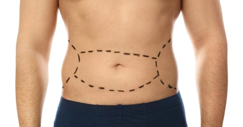 Tummy Tuck for a Flat Belly and Safe Relief from Excess Skin