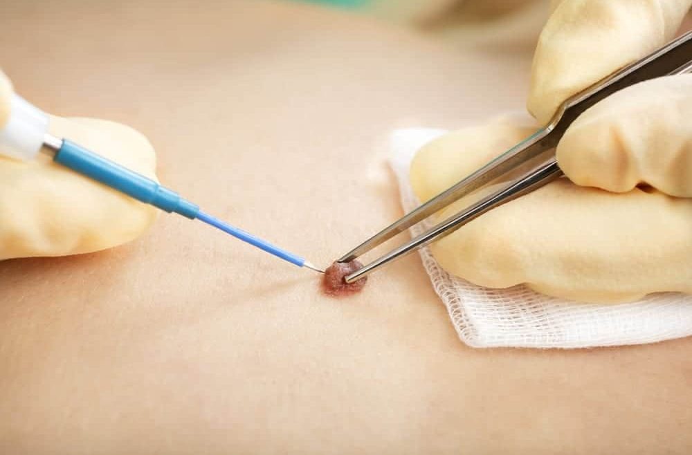 Skin Wart Removal