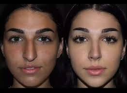 Top Questions to Ask Before Rhinoplasty Surgery in Dubai