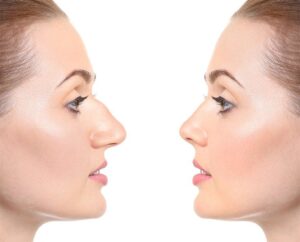 Safe Rhinoplasty in Riyadh