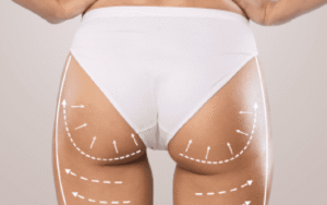 Butt Fat Transfer in Dubai: Combining Liposuction with Enhancement