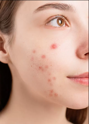 Έκζεμα: Αναγνώριση, θεραπεία και συμβουλές από εξειδικευμένο δερματολόγο