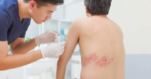 How to Prepare for the Onset of Shingles Symptoms and Prevent Flare-ups