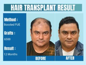 Understanding Hair Transplant Cost in Delhi A Complete Guide to Making the Right Investment