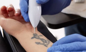 Picosure Tattoo Removal Solutions for Fading Tattoos Safely
