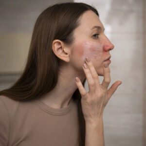 Best Acne Medications and Therapies Riyadh
