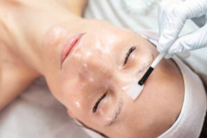 Common Myths About Chemical Peels Debunked by Skin Experts