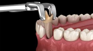Tooth Extraction