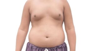 Gynecomastia
