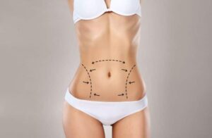 Who Is the Right Candidate for Liposuction in Dubai