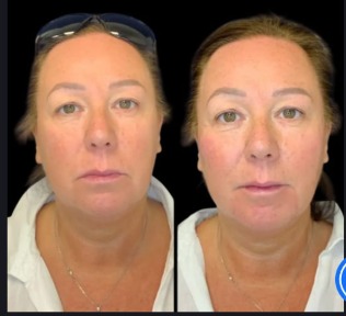 Best Non-surgical facelift Treatments in Dubai for Youthful Skin
