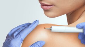 Skin Wart Removal