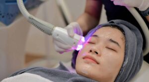 Laser Skincare Treatments