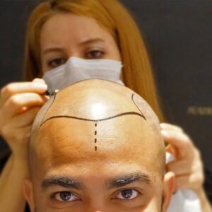 Hair Transplant for Men and Women Seeking Real, Lasting Change