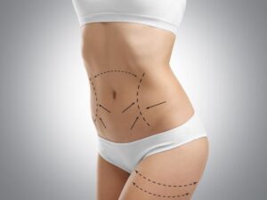 Transform Your Figure with Tummy Tuck for a Confident New You