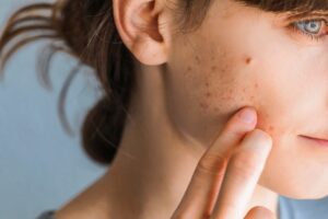 How to Choose the Best Acne Treatment for Fast and Lasting Results