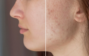 Are Acne Scar Treatments in Dubai Suitable for All Ages?