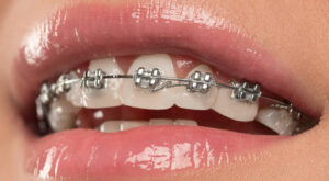 Braces Dubai: Pain Relief & Comfort Options