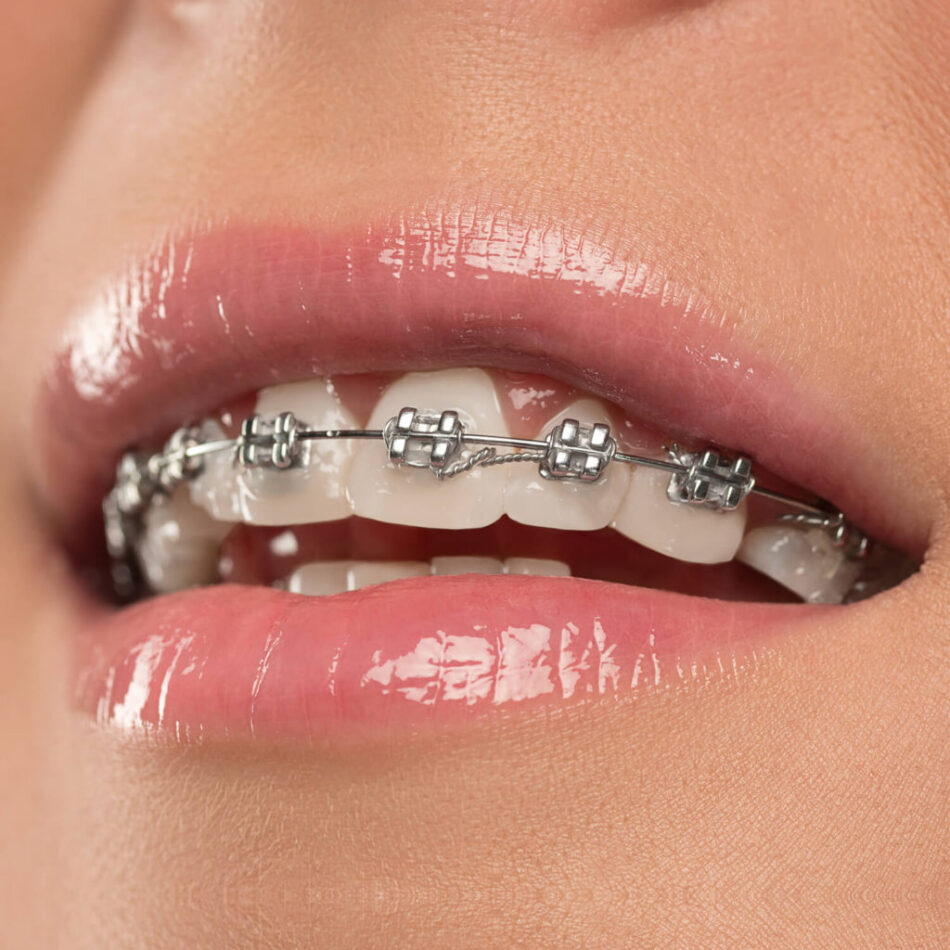 Braces Dubai: Pain Relief & Comfort Options