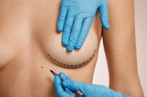 What to Expect from a Breast Lift in Dubai