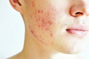 Can acne scar treatment improve self-confidence in Dubai?