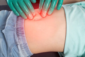 Hernia Surgery Cost Breakdown: What Influences Prices?