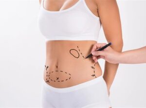 Safe and Fast Vaser 4D Liposuction for a Defined Athletic Look