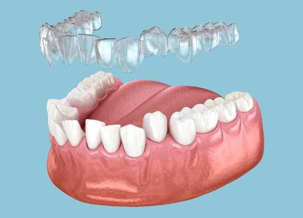 invisalign Bury