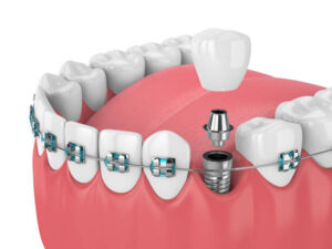 Dental Implants Cost in Riyadh Explained for New Patients