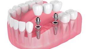 Dental Crowns and Bridges