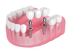 Can Dental Crowns and Bridges in Dubai Replace Missing Teeth?