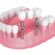 Dental Crowns and Bridges