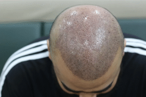 Do Transplanted Hairs Grow Like Normal Hair?