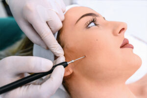 Dubai Laser Mole Removal: Top Rated by Experts