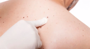 Effective Home Remedies for Birthmark Fading