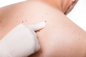 Effective Home Remedies for Birthmark Fading