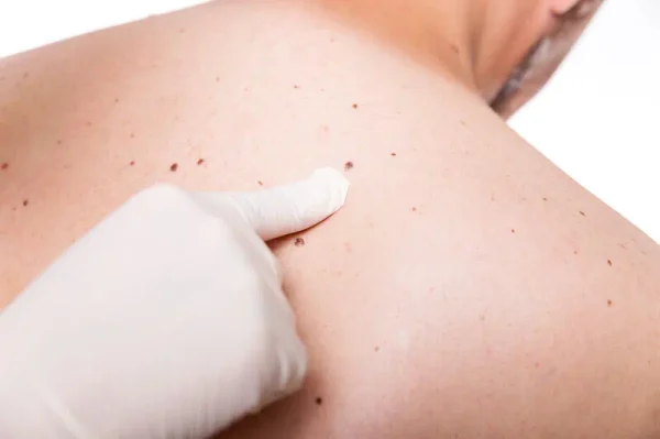 Effective Home Remedies for Birthmark Fading