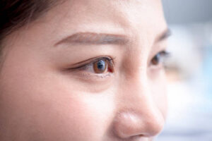 Everything You Need to Know About Eye Lift Surgery in Riyadh