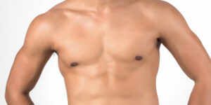 Steps to Prepare for Gynecomastia Surgery in Riyadh Successfully