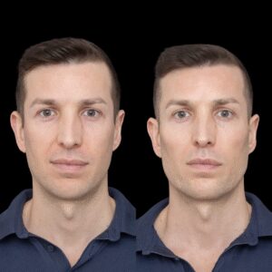What Makes the Best Plastic Surgeons in Dubai Experts in Jawline Fillers?