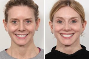 Patient Reviews of the Best Doctors in Dubai for Thread Lifts