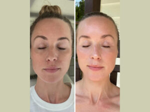 Elevate Your Confidence with Fotona 4D Laser Treatments in Dubai