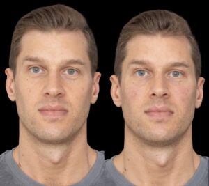 under eye fillers in dubai