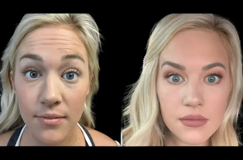 Is Botox Treatment in Dubai Safe? Expert Insights You Can Trust