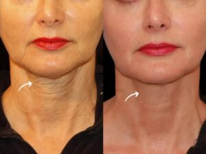 Sculptra Treatment in Dubai for Wrinkle Reduction