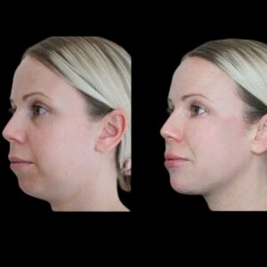 Jawline Fillers for Women at the Best Aesthetic Clinic in Dubai