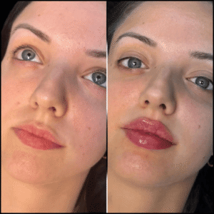 Best Plastic Surgeons in dubai for Fillers: Natural Volume Restoration