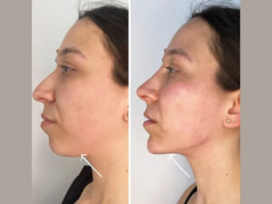 Premium Endolift at the Best Aesthetic Clinic in Dubai