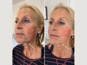 How the Best Plastic Surgeon in Dubai Achieve Natural Results with Endolift