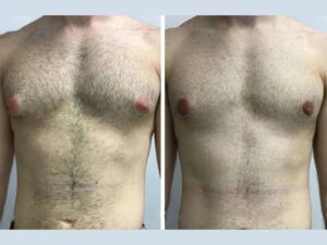 Global Trends in Male Breast Reduction vs. Gynecomastia in Dubai